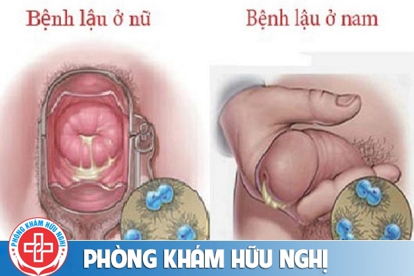 benh-lau-co-chua-khoi-han-duoc-khong
