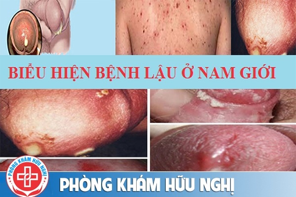 benh-lau-o-nam-gioi