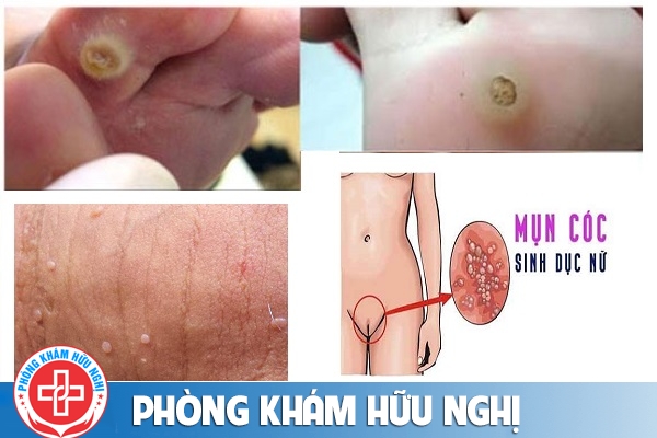 dau-hieu-mun-coc
