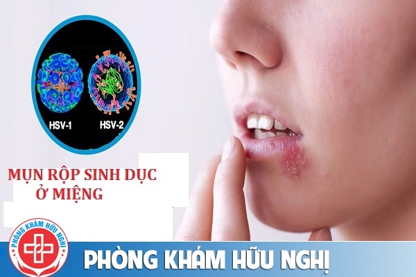 Mụn rộp sinh dục ở miệng có dấu hiệu như thế nào?