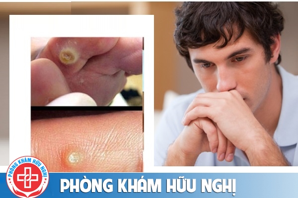 Dấu hiệu mụn cóc sinh dục và cách điều trị hiệu quả