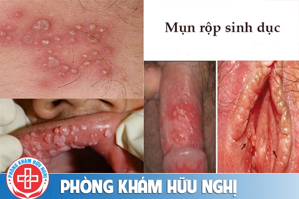 mun-rop-sinh-duc