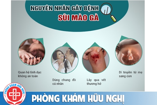 Nguyên nhân gây bệnh sùi mào gà