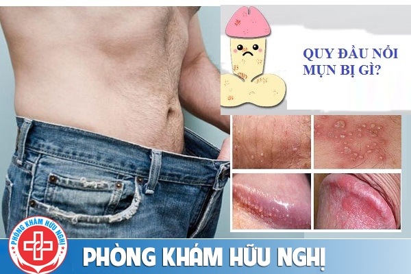 quy-dau-noi-mun