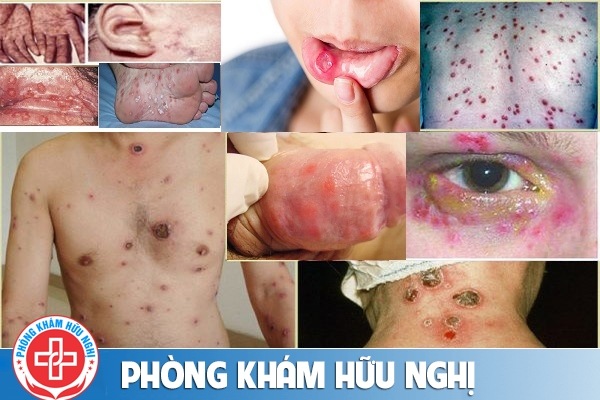 hinh-anh-benh-giang-mai-o-nam-gioi-e1574502902536