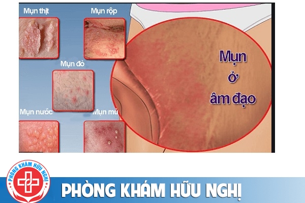 Âm đạo chảy mủ do lậu