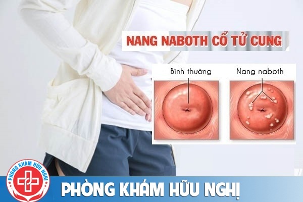 Nang naboth cổ tử cung là gì có nguy hiểm không?