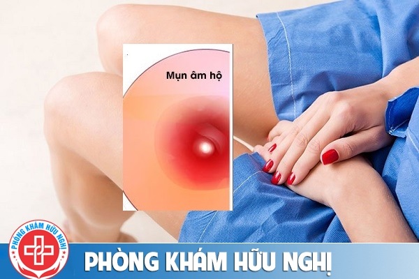 Nổi mụn ở âm đạo âm vật vùng kín nữ là bị bệnh gì?
