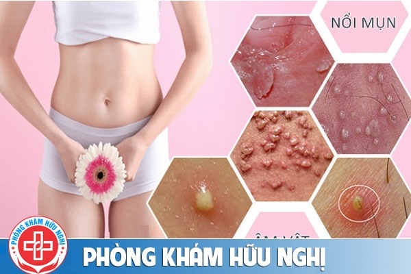 noi-mun-vung-kin