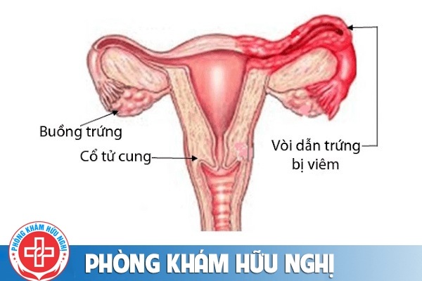 Viêm ống dẫn trứng là bệnh gì chữa được không?