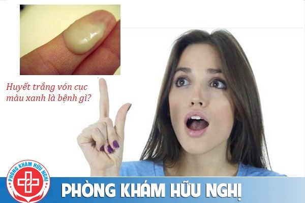 Huyết trắng vón cục màu xanh là dấu hiệu bệnh gì?