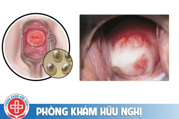 chlamydia-la-gi