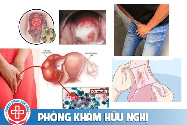 dau-hieu-benh-chlamydia