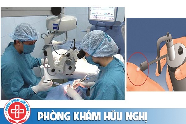 Đốt gai sinh dục có hiệu quả không chi phí bao nhiêu?
