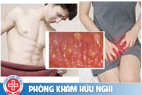 Cách nhận biết và điều trị u nhú sinh dục hiệu quả