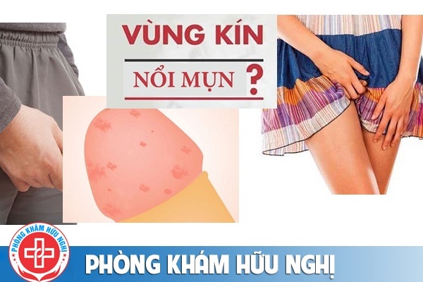 Bộ phận sinh dục nổi hạt li ti phải làm sao?