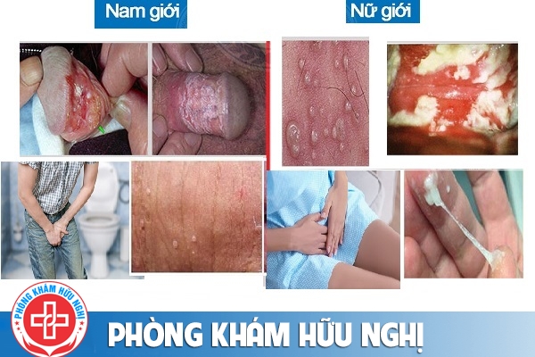 dau-hieu-viem-nhiem-o-bo-phan-sinh-duc