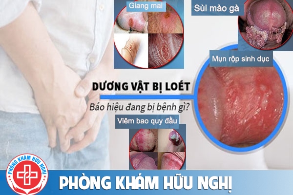 lo-loet-duong-vat-benh-gi