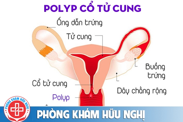Polyp cổ tử cung là căn bệnh như thế nào và những điều cần chú ý