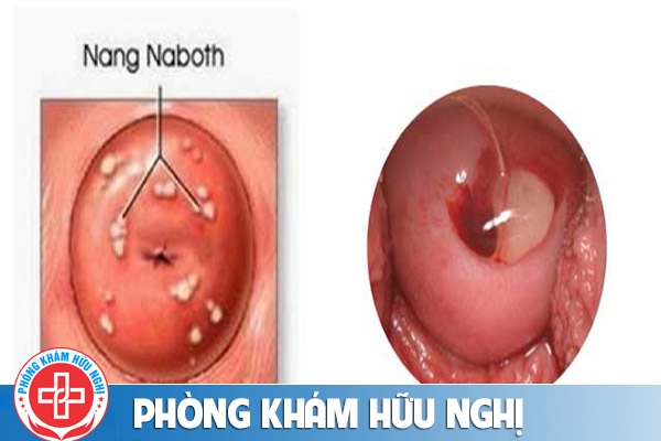 Nang naboth cổ tử cung do đâu và phương pháp điều trị hiệu quả