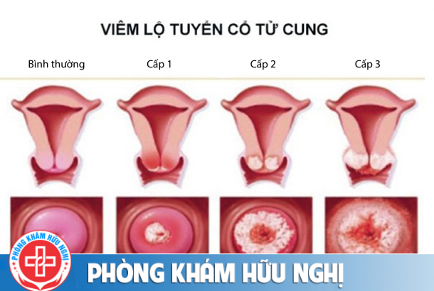 viem-lo-tuyen-co-tu-cung-cap-do-2