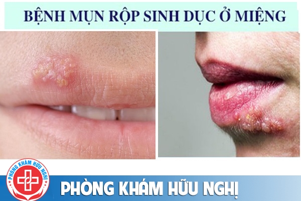 benh-mun-rop-sinh-duc-o-mieng