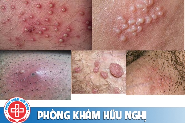 Âm đạo chảy mủ do lậu