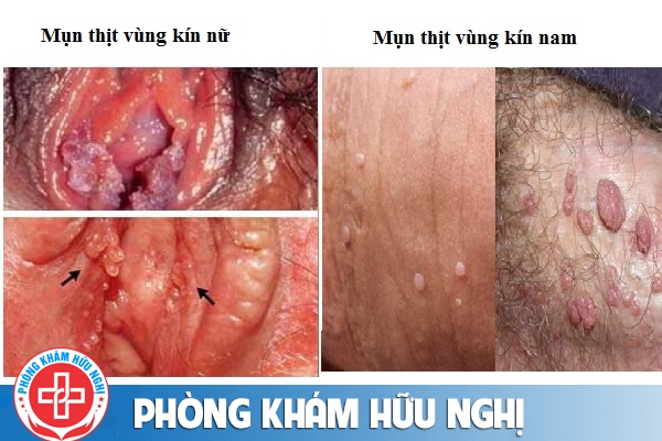 mun-thit-vung-kin-nguy-hiem