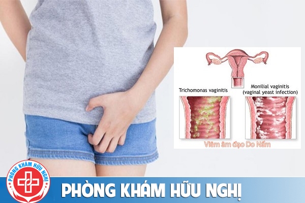 Ngứa môi lớn vùng kín nữ nguyên nhân và cách điều trị