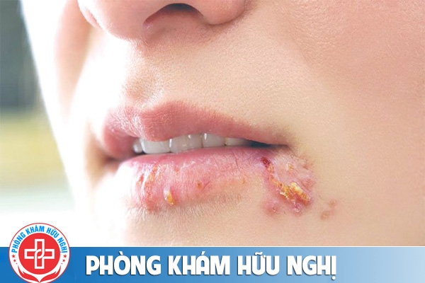 Nổi mụn ở miệng là bị bệnh gì?