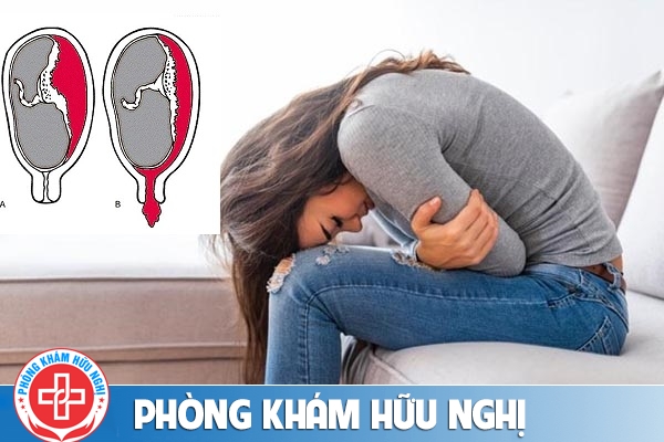 Dấu hiệu sót thai và cách điều trị