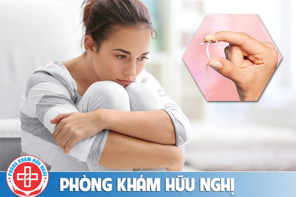 Tháo vòng tránh thai và những điều bạn cần biết