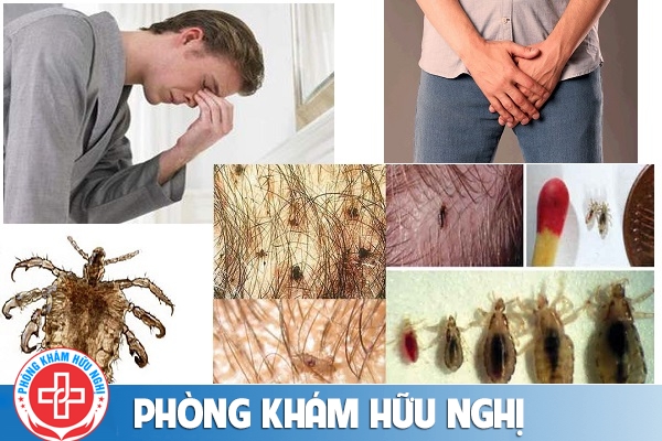 Bệnh rận mu cách chữa trị hiệu quả nhất