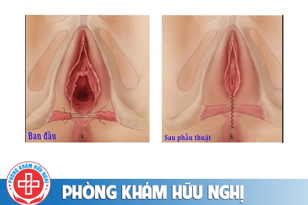 cach-se-khit-vung-kin