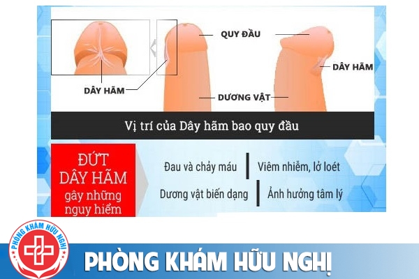 Đứt dây hãm bao quy đầu: cẩn thận nguy hiểm!