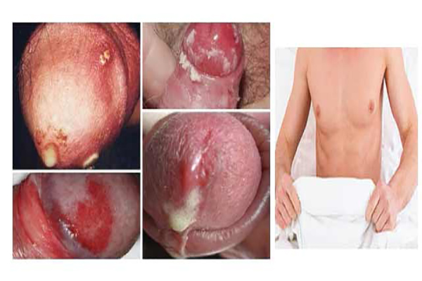Bệnh lậu ở nam giới: triệu chứng & cách phòng ng