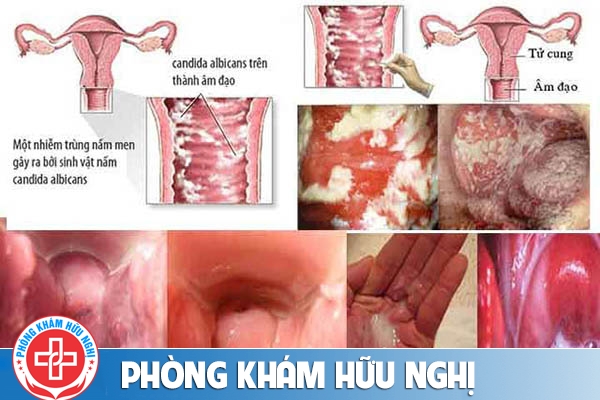Nấm candida nguyên nhân, triệu chứng và cách khắc phục hiệu quả