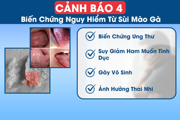 4 biến chứng nguy hiểm từ bệnh sùi mào gà