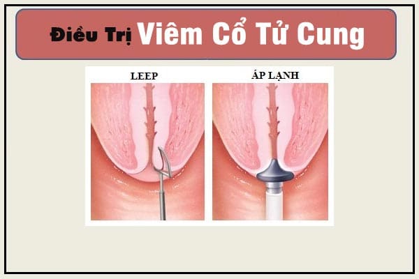 viem-co-tu-cung-la-gi-va-nhung-dieu-can-luu-y-5