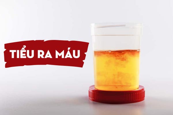Tiểu ra máu – Tiềm ẩn nhiều nguy hiểm khôn lường