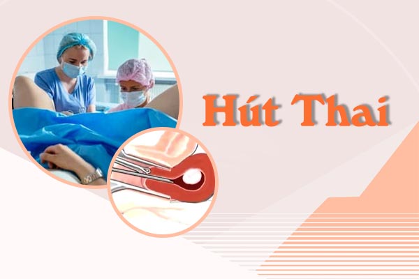 Tìm hiểu về biện pháp hút thai hiện nay