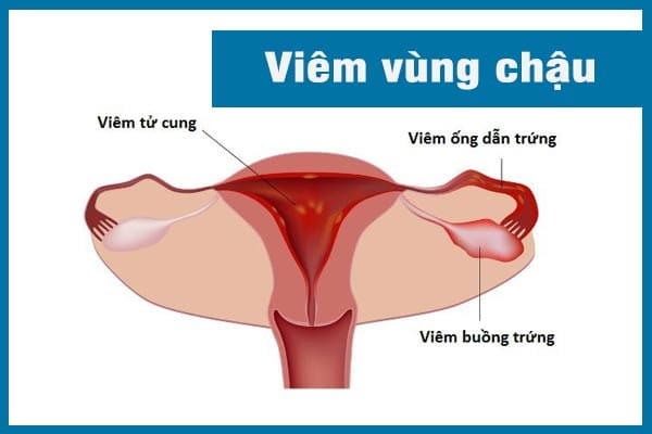 tong-hop-cach-chua-benh-phu-khoa-thuong-gap-7