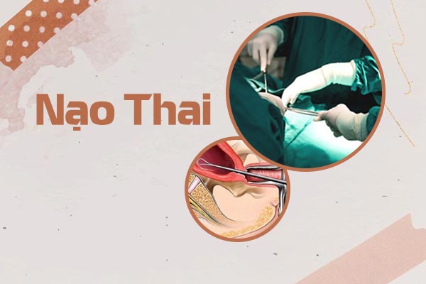 Tổng hợp thông tin về nạo thai