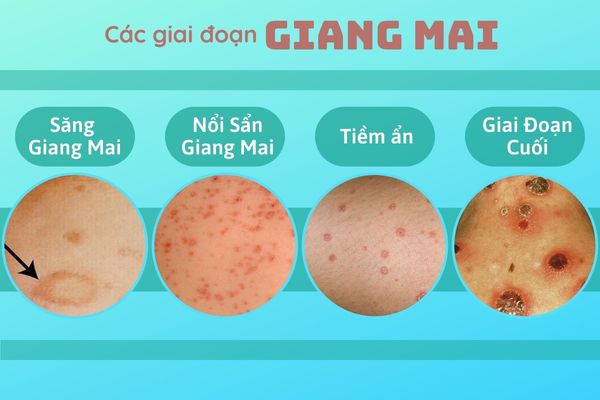 cac-thong-tin-can-biet-ve-giang-mai-2
