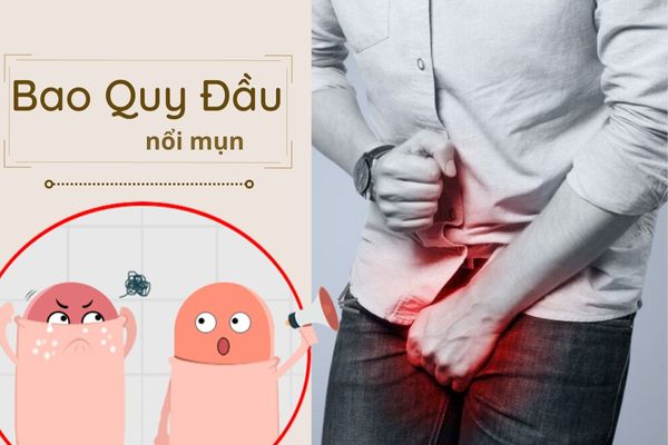 Tại sao bao quy đầu nổi mụn và điều trị thế nào?