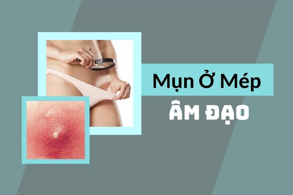 Cẩn thận trước hiện tượng nổi mụn ở mép âm đạo