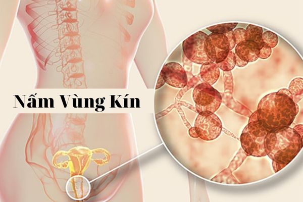 Cảnh báo nấm vùng kín ở nữ giới