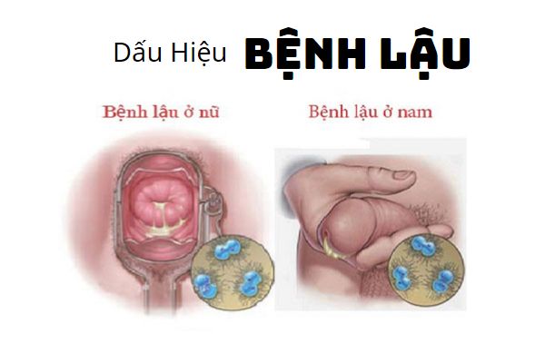 benh-lau-lay-qua-dau-va-con-duong-nao-pho-bien-nhat-1