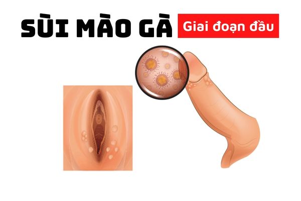 the-nao-la-sui-mao-ga-giai-doan-dau-va-dieu-tri-ra-sao-1