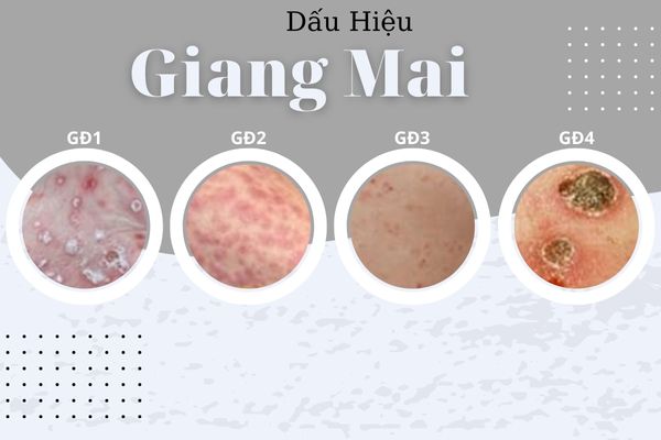 dau-hieu-giang-mai-qua-tung-giai-doan-va-bien-phap-chua-tri-1